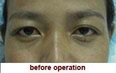 plastic-surgery-blepharoplasty